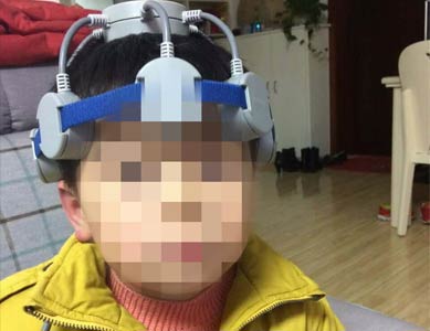 家用经颅磁治疗仪治疗抽动症